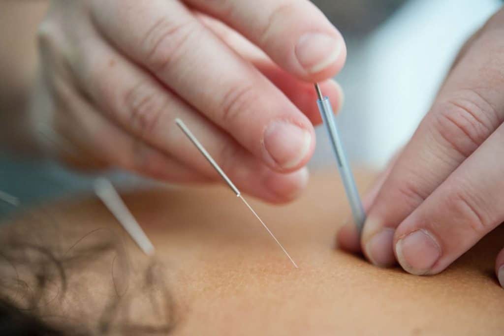 Er akupunktur det rigtige for dig?